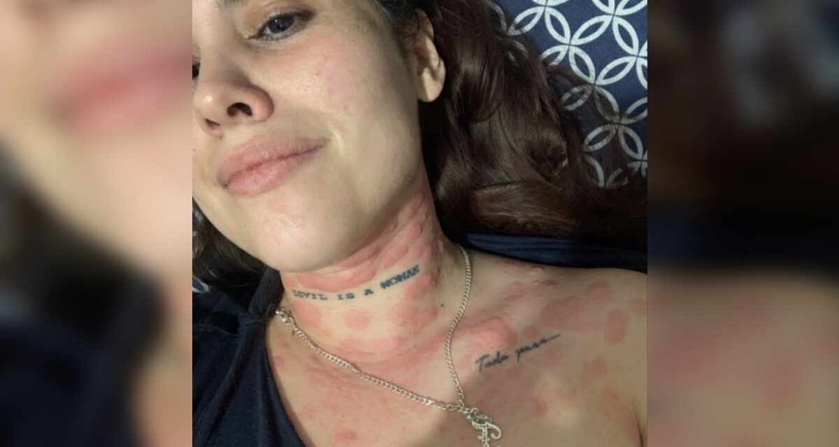 De comezón a ronchas en todo el cuerpo: Fernanda denuncia grave urticaria por agua contaminada en Guadalajara